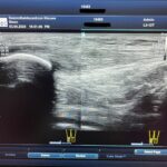 Echografie pees slide 4