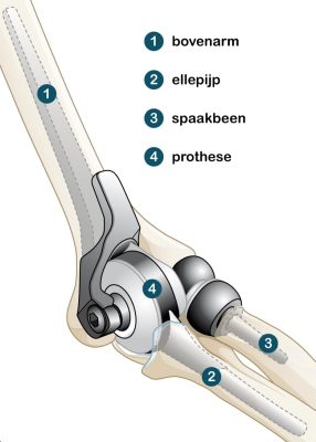 volledige elleboogprothese
